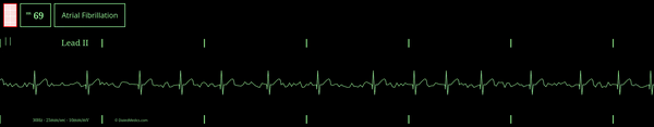 Software generated monitor capture (.gif) of atrial fibrillation.